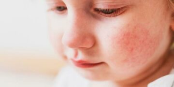 Advierten que la dermatitis atópica afecta al 30% de los menores