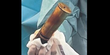 Un hombre ingresó a la guardia de un hospital con una bomba de la Primera Guerra Mundial en el recto