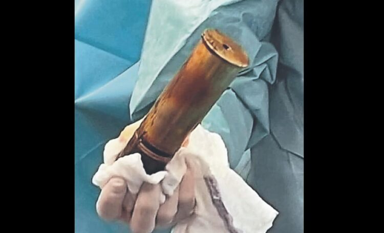 Un hombre ingresó a la guardia de un hospital con una bomba de la Primera Guerra Mundial en el recto