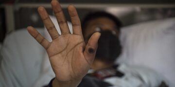 Se registró la segunda muerte por viruela símica en la Argentina