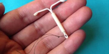 Nació con el DIU de su mamá en la mano