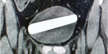 Introdujo su juguete sexual en el orificio equivocado y terminó a los gritos en el hospital