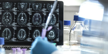 Un fármaco frenó la progresión del Alzheimer un 35% en un ensayo