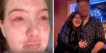 Descubrió que es alérgica a su novio y su extraño caso se volvió viral