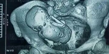 Fua al médico y se enteró de que vivió la mitad de su vida con un feto en su vientre