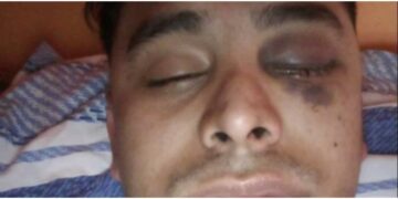 Un joven se atrasó en el pago del alquiler y perdió un ojo tras recibir un culatazo del dueño