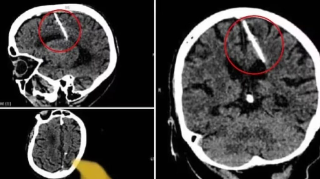 A los 80 años, se enteró de que vivió con una aguja clavada en el cerebro desde niña y la cruda explicación la impactó