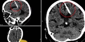 A los 80 años, se enteró de que vivió con una aguja clavada en el cerebro desde niña y la cruda explicación la impactó
