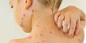 Salud notificó 487 casos de infección por Streptococcus pyogenes en el país