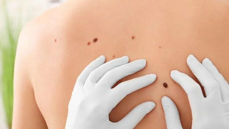 Advierten que lesiones inofensivas o lunares podrían ser signos de alarma en el cáncer de piel