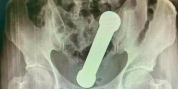 Lo operaron para extraerle un objeto del cuerpo luego de participar en un peligroso juego sexual