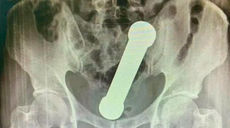 Lo operaron para extraerle un objeto del cuerpo luego de participar en un peligroso juego sexual
