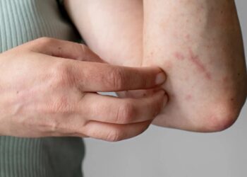 Lesiones cutáneas como secuela del dengue