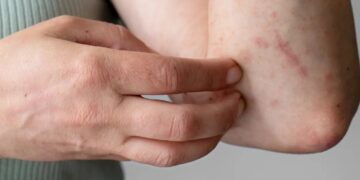 Lesiones cutáneas como secuela del dengue