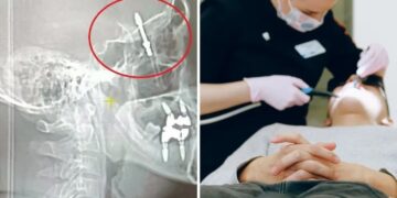 Fue al dentista por un dolor de muelas, pero el profesional hizo fuerza de más y le hizo un implante en el cerebro