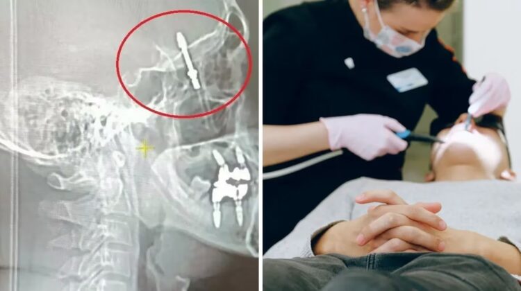 Fue al dentista por un dolor de muelas, pero el profesional hizo fuerza de más y le hizo un implante en el cerebro