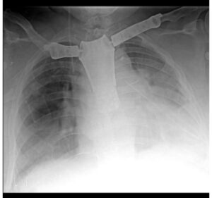 El Hospital Ferreyra marca un hito al realizar una cirugía de tórax de alta complejidad
