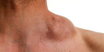 Un nuevo tratamiento para el linfoma de Hodgkin reduce un 38% el riesgo de muerte