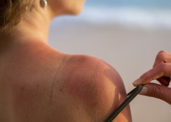 Cómo cuidar la piel ante las altas temperaturas y la exposición al sol