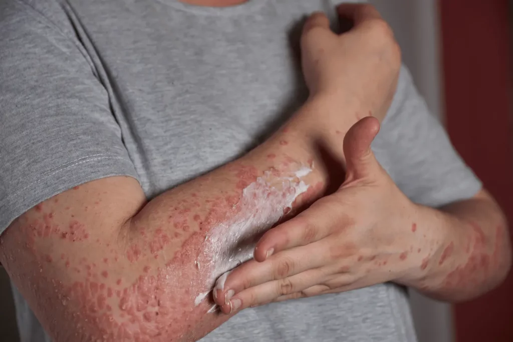 Cómo es la psoriasis, la enfermedad que padecen 800.000 argentinos