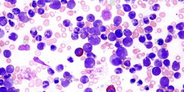Avances científicos mejoran el pronóstico de la leucemia más frecuente