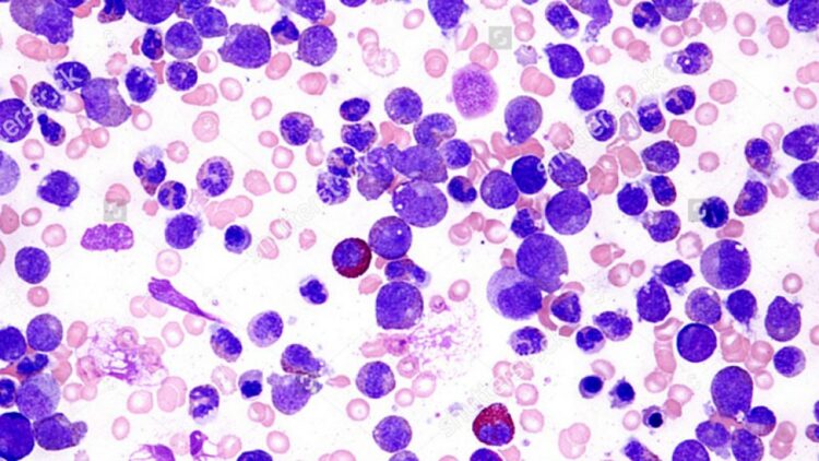 La leucemia mieloide aguda es considerada la más frecuente.