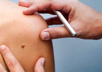 Día Mundial del Melanoma