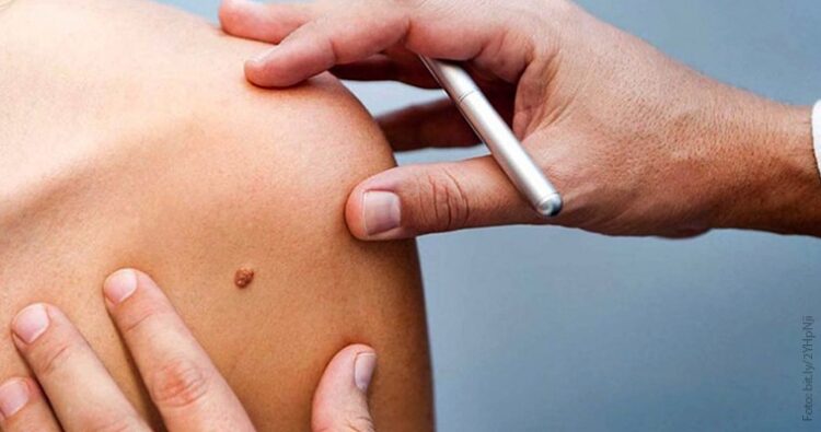 Día Mundial del Melanoma