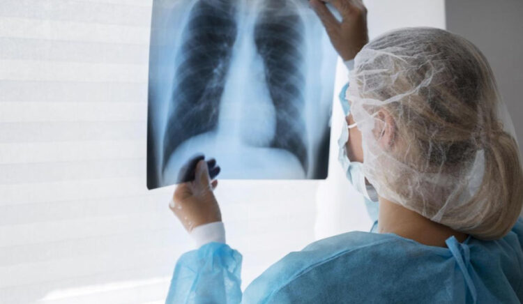 Preocupante aumento de casos de tuberculosis: creció un 65,9% entre 2020 y 2025.