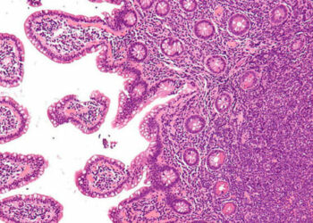 El linfoma de células de manto es un cáncer hematológico.