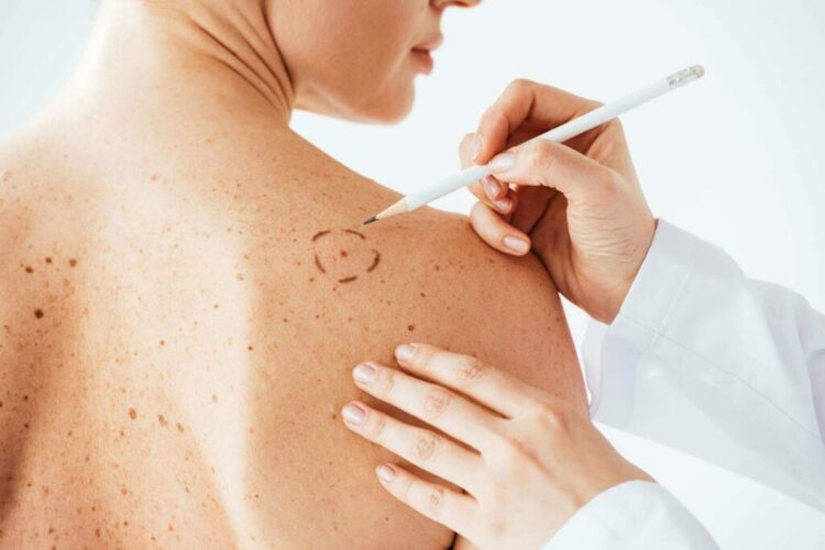 Campaña de prevención de lunares.