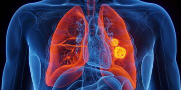 Advierten que el cáncer de pulmón podría aumentar casi un 80% para 2050 Día Mundial del Cáncer de Pulmón