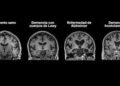 Científicos descubren cómo estimular la defensa del cerebro para combatir el Alzheimer