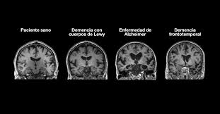 Científicos descubren cómo estimular la defensa del cerebro para combatir el Alzheimer