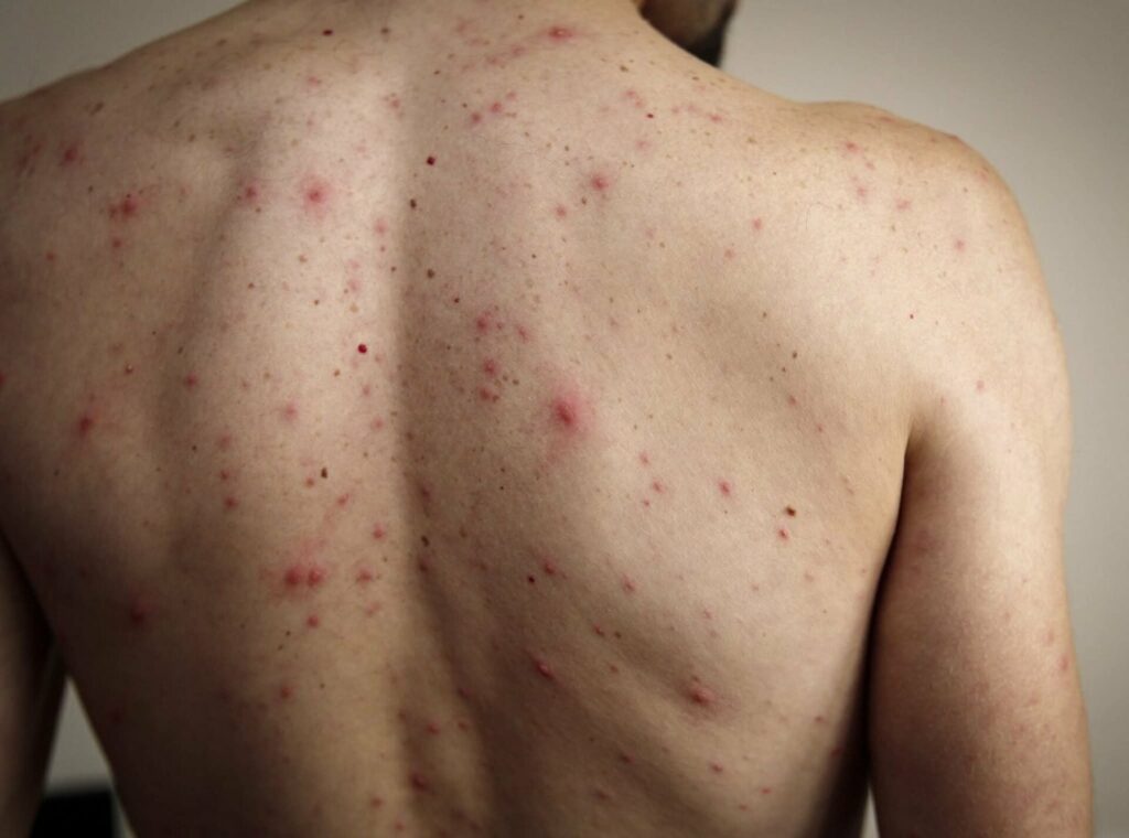 Nuevo caso de Sarampión importado: refuerzan el llamado a vacunarse