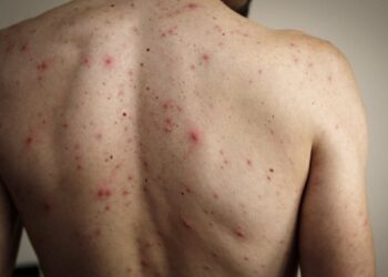 Nuevo caso de Sarampión importado: refuerzan el llamado a vacunarse