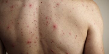 Sarampión importado y refuerzan el llamado a vacunarse