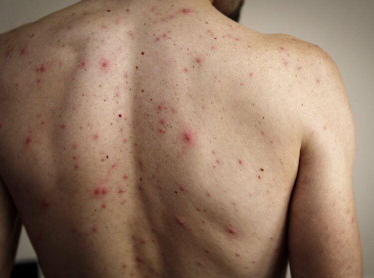 El Ministerio de Salud de la Nación Argentina emitió una alerta tras confirmarse un caso importado de sarampión y reforzó el llamado a la vacunación para prevenir nuevos contagios y evitar la reintroducción del virus en el país.