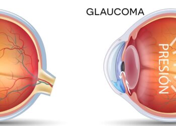 La enfermedad ocular silenciosa que ya afecta a más de un millón de argentinos
