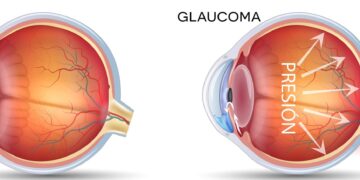 La enfermedad ocular silenciosa que ya afecta a más de un millón de argentinos La enfermedad ocular silenciosa que ya afecta a más de un millón de argentinos