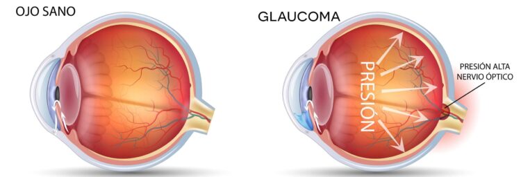 La enfermedad ocular silenciosa que ya afecta a más de un millón de argentinos El glaucoma es una enfermedad ocular silenciosa que puede provocar ceguera irreversible si no se detecta a tiempo, por lo que especialistas recomiendan controles oftalmológicos anuales desde los 40 años.
