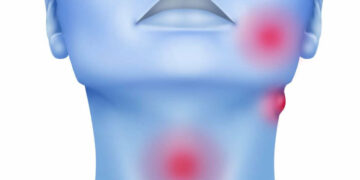 Advierten un aumento de los casos de cáncer de cabeza y cuello vinculados al VPH