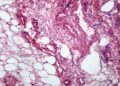 Un estudio del Conicet analizó el impacto del cáncer renal en el tejido adiposo Conicet