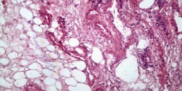 Un estudio del Conicet analizó el impacto del cáncer renal en el tejido adiposo Conicet