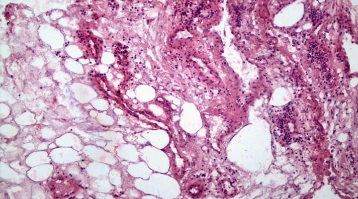 Un estudio del Conicet analizó el impacto del cáncer renal en el tejido adiposo Conicet